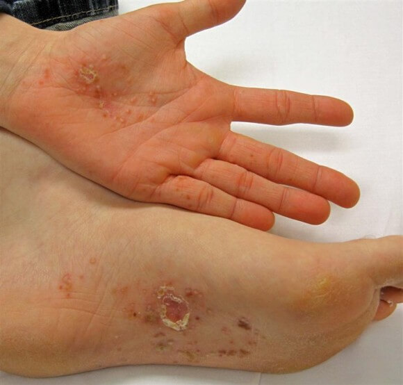 Dyshidrotic Eczema on the hand and foot