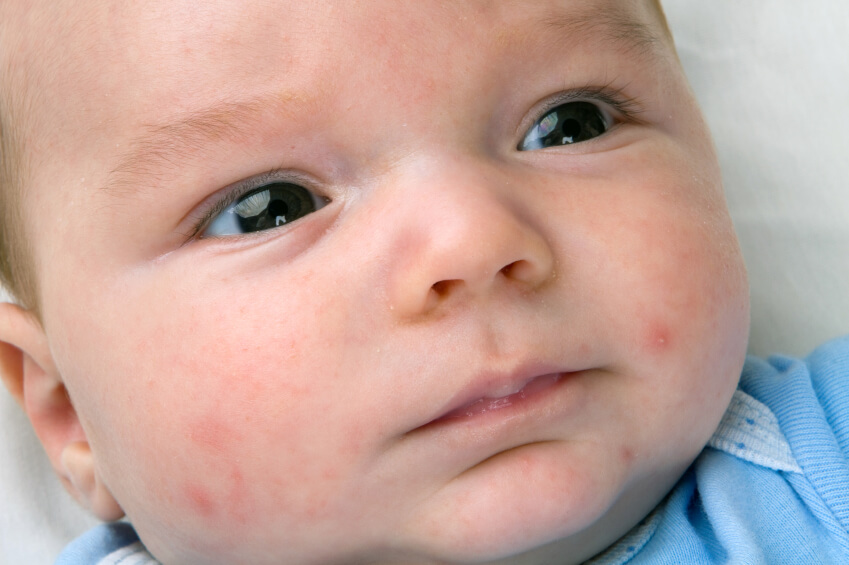 Baby acne affects about a 1/3 of all babies born. Eczema-Ltd III has been used to treat many newborn babies.