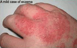 A mild case of contact ezcema