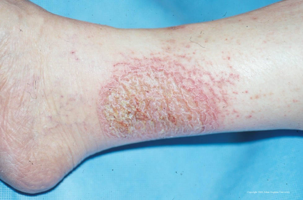 Eczema Craquele on the side of the leg, above ankle