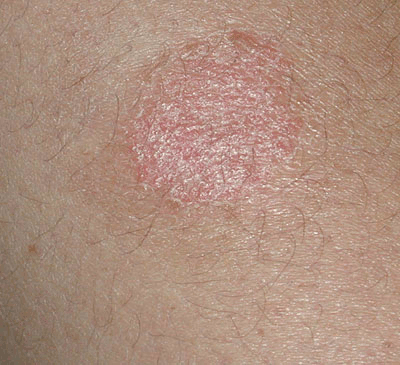 Discoid eczeme, common trait is it's round coin shape lesion