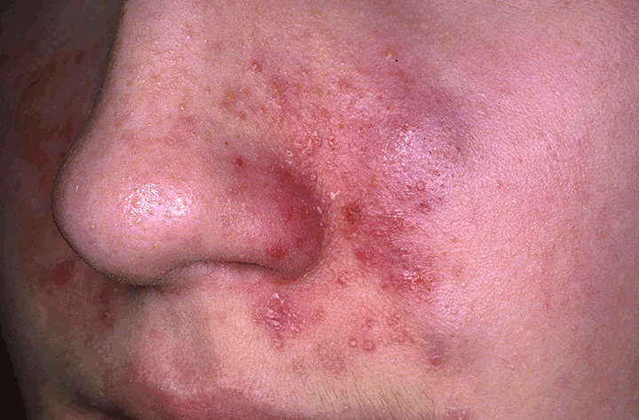 Seborrheic Eczema around the nose and upper lip